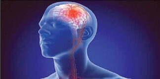 Regular exercise, lifestyle changes could lower risk of stroke