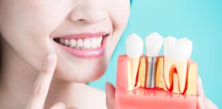 Is A Dental Implant Procedure Safe? Learn Everything About It