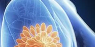 Yoga, Exercise Associated With Better Survival in Nonmetastatic Breast Cancer