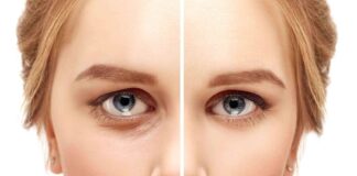Treatments To Fix Eye Wrinkles That You Should Know