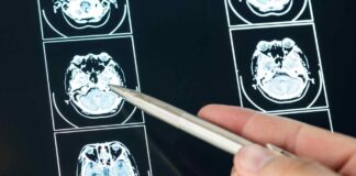 The Actions A TBI Victim Should Take Following An Accident