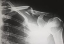 How To Rebuild Your Health And Financial Wellbeing After An Accident