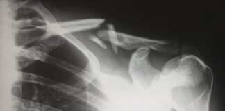 How To Rebuild Your Health And Financial Wellbeing After An Accident