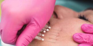 Customized PDO Thread Lifts For Personalized Cosmetic Treatment