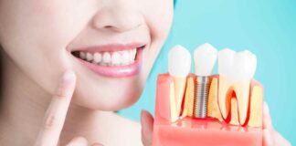 What Are The Stages Of Dental Implants?