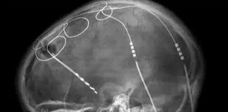 A Pacemaker for Parksinson’s, Alzheimer’s? Deep Brain Stimulation, Explained